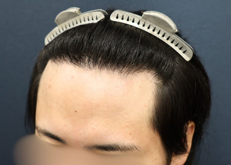 症例写真