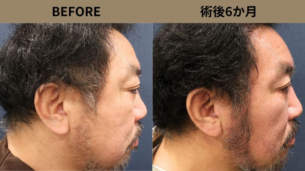 【植毛 症例更新】50代男性｜ヒゲ植毛・他院修正800グラフト