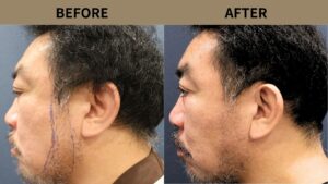 【自毛植毛 症例更新】50代男性｜ヒゲ植毛・他院修正800グラフト