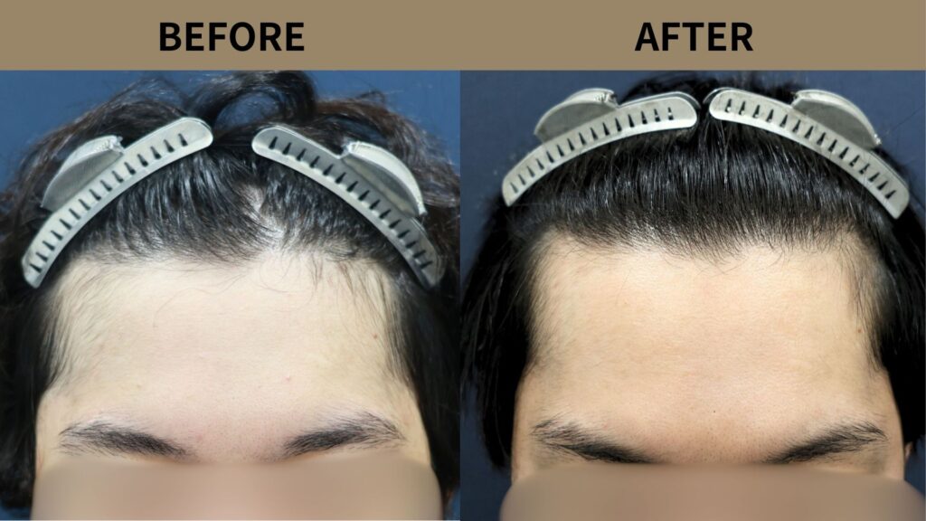 【植毛 症例更新】20代男性｜生え際の薄毛800グラフト