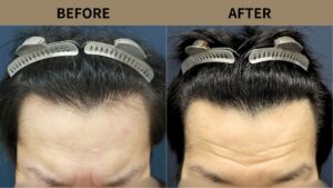 【植毛 症例更新】40代男性｜生え際の薄毛・他院修正900グラフト