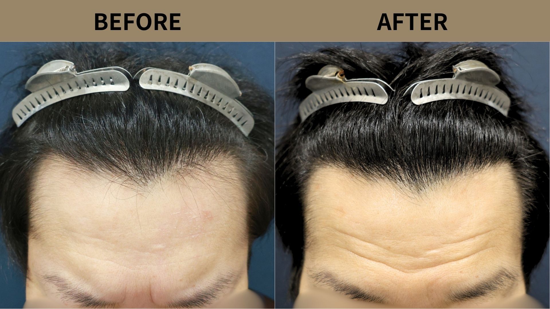 【植毛 症例更新】40代男性｜生え際の薄毛・他院修正900グラフト