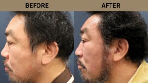 【植毛 症例更新】50代男性｜ヒゲ植毛・他院修正800グラフト