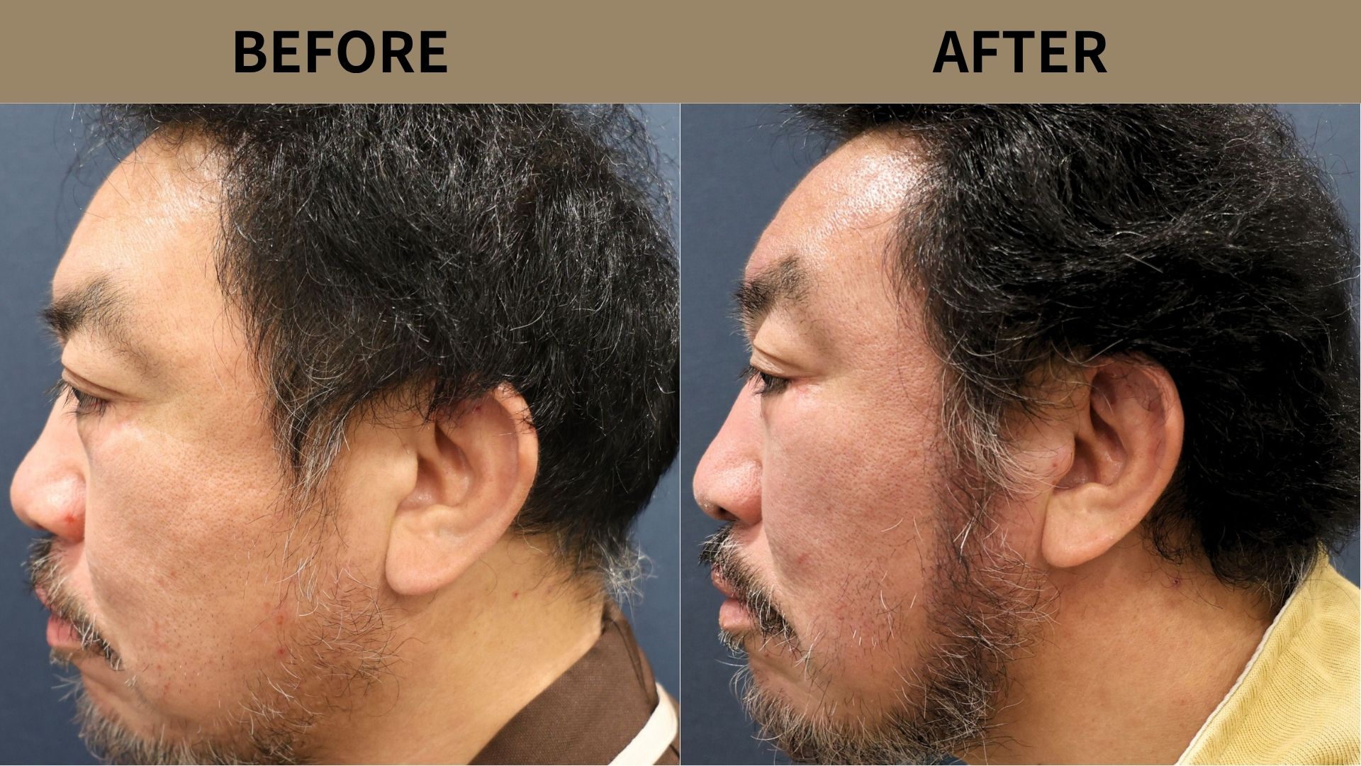 【植毛 症例更新】50代男性｜ヒゲ植毛・他院修正800グラフト