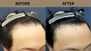 【植毛 症例更新】30代男性｜生え際の薄毛・他院修正1000グラフト