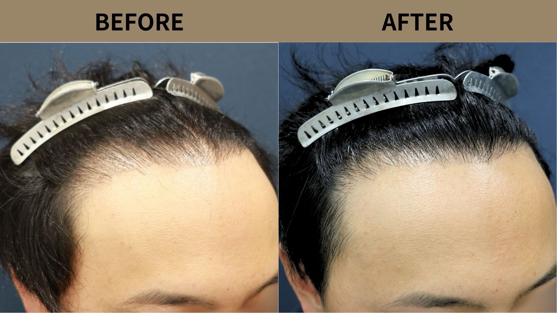 【植毛 症例更新】30代男性｜生え際の薄毛・他院修正1000グラフト