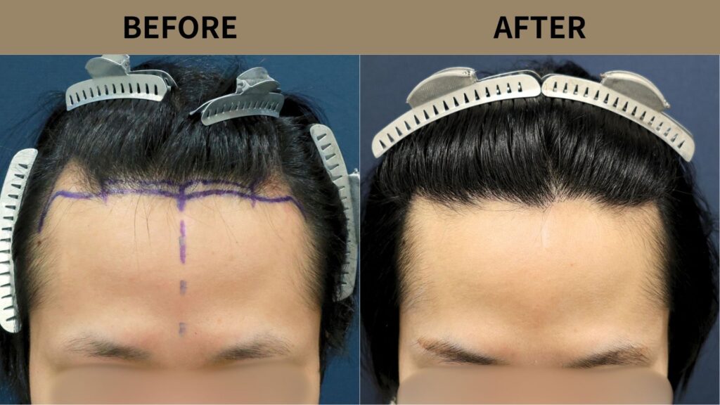 【植毛 症例更新】20代男性｜生え際の薄毛1300グラフト