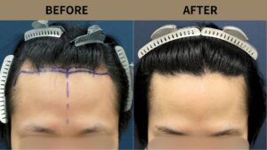 【植毛 症例更新】20代男性｜生え際の薄毛1300グラフト
