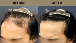 【植毛 症例更新】20代男性｜生え際1500グラフト 　