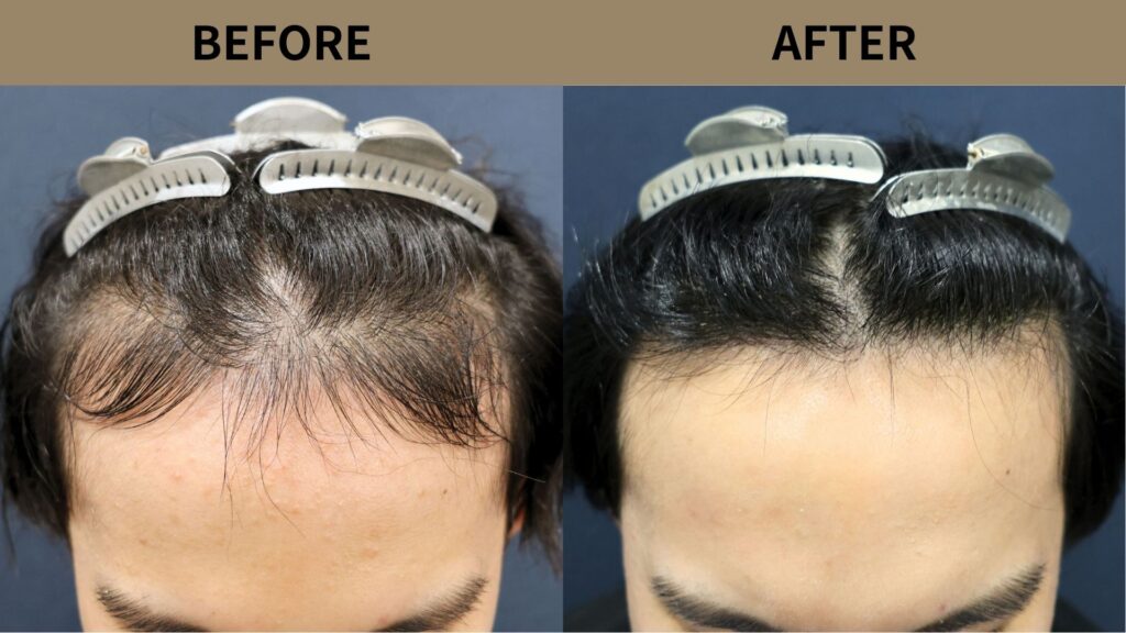 【植毛 症例更新】20代男性｜生え際1500グラフト 　