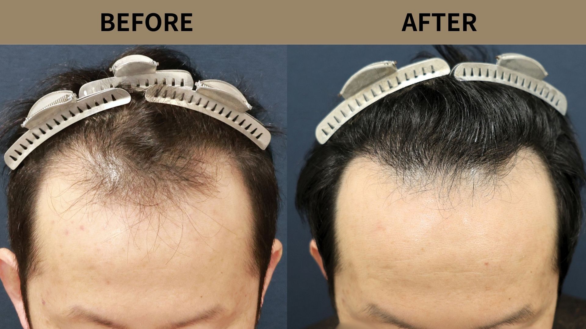 【植毛 症例更新】40代男性｜生え際・M字の薄毛1600グラフト