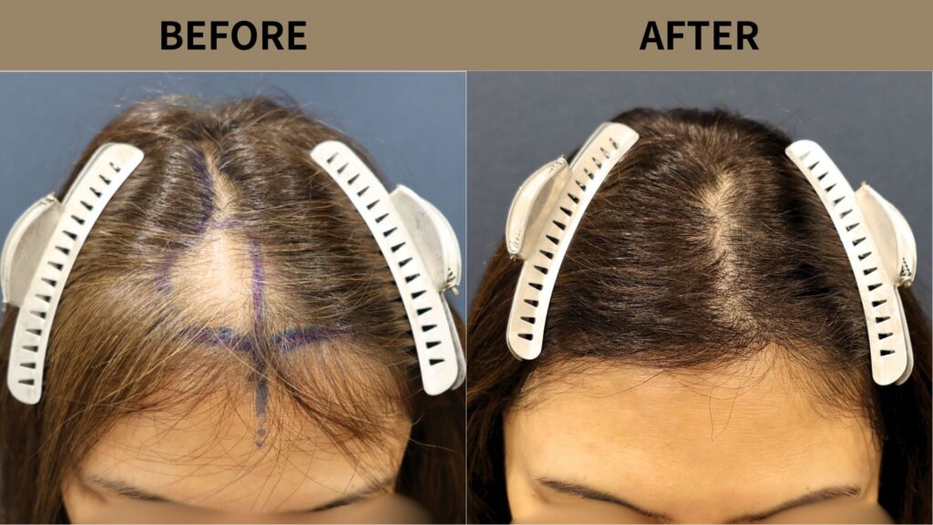 【植毛 症例更新】50代女性｜前頭部・瘢痕1500グラフト