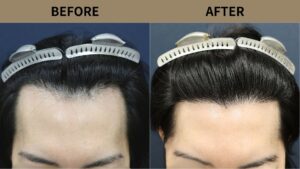 【植毛 症例更新】40代 男性｜生え際の薄毛・他院修正・当院2回目1200グラフト