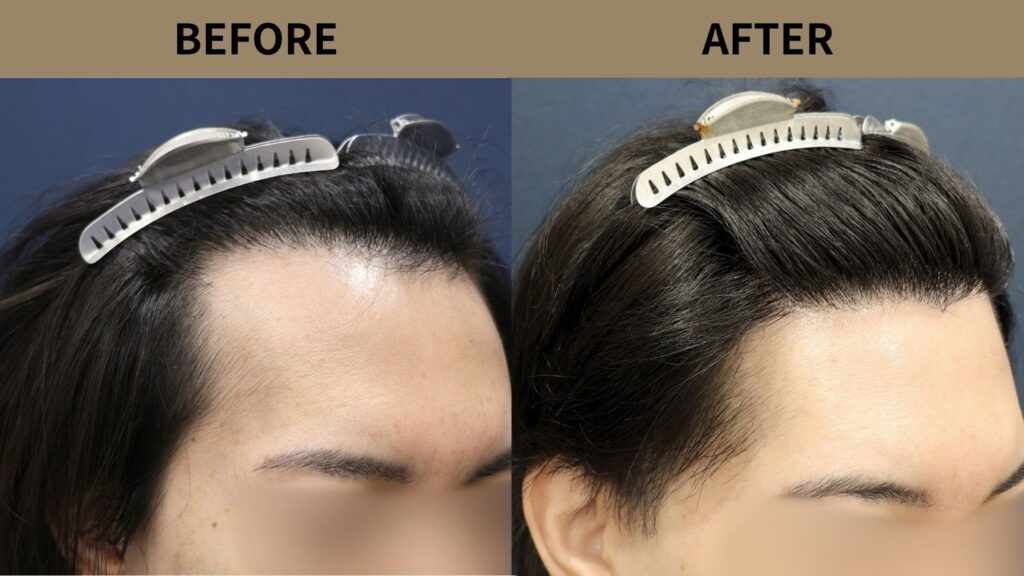 【植毛 症例更新】40代 男性｜生え際の薄毛・他院修正・当院2回目1200グラフト