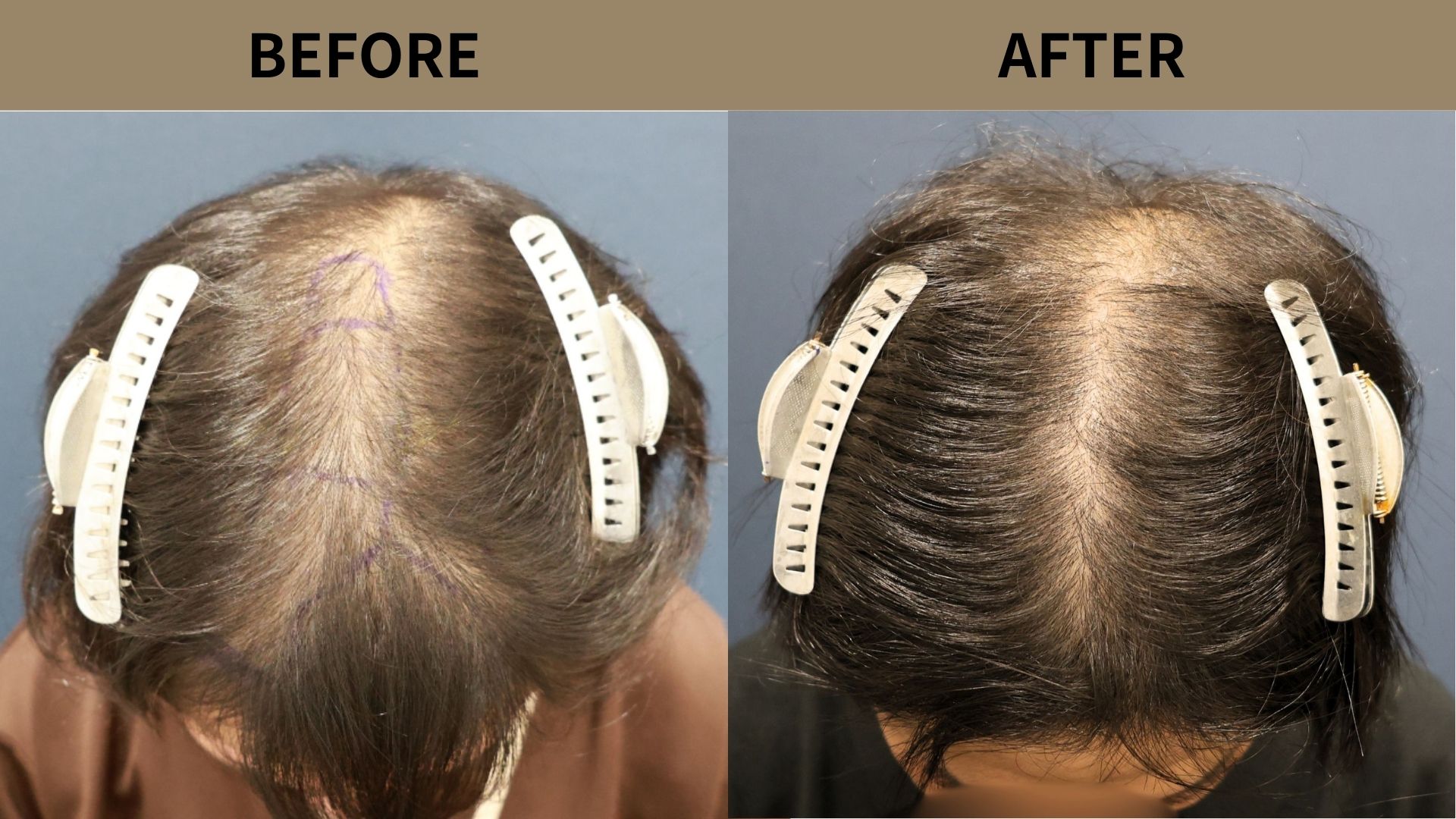 【植毛 症例更新】30代男性｜前頭部～頭頂部の薄毛600グラフト