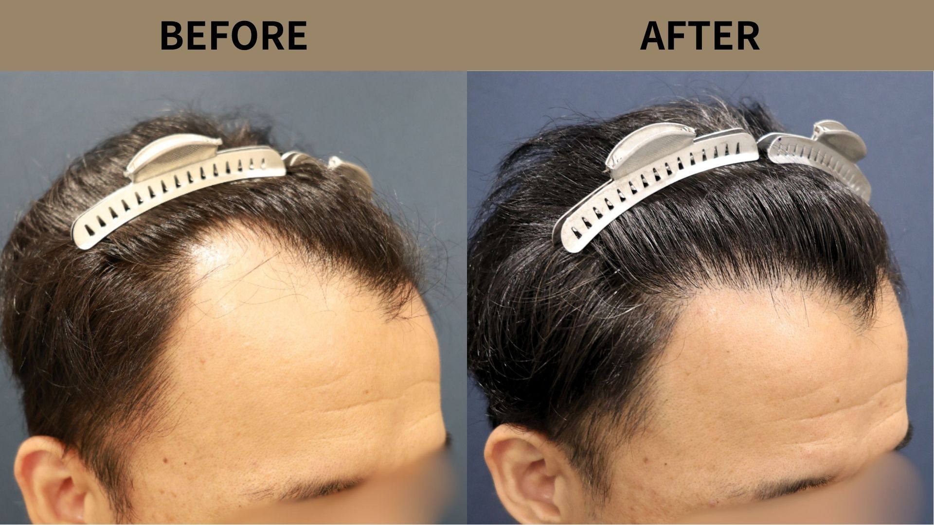 【植毛 症例更新】40代男性｜生え際・M字の薄毛1800グラフト