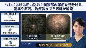 つむじはげは思い込み？頭頂部の薄毛を見分ける基準や原因、治療法までを医師が解説