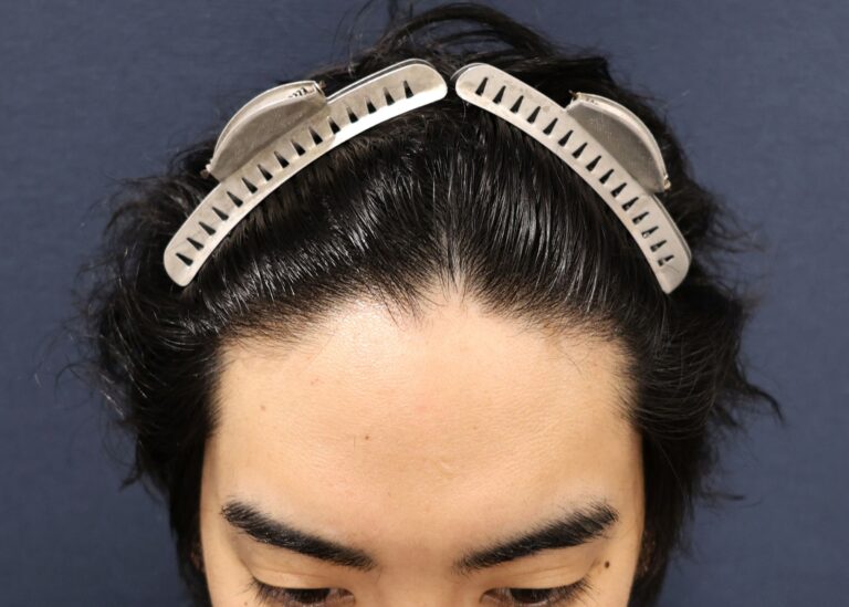 症例写真