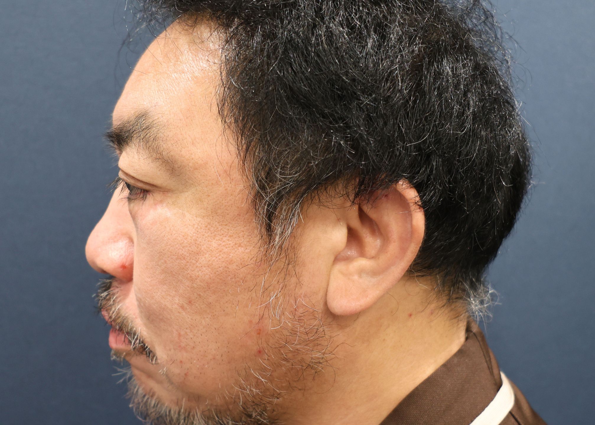 施術前