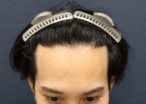 術後1年