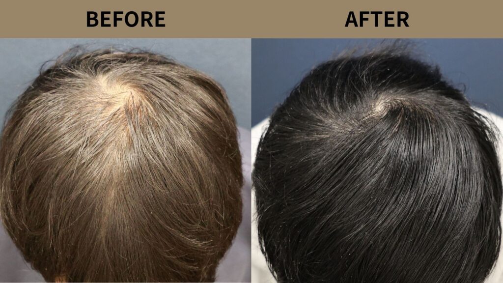 【植毛 症例更新】40代男性｜頭頂部800グラフト