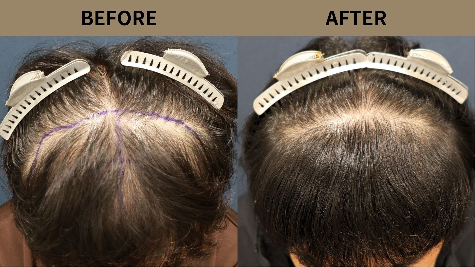 【植毛 症例更新】50代男性｜生え際・前頭部・他院修正2200グラフト