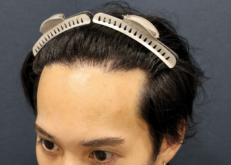 症例写真