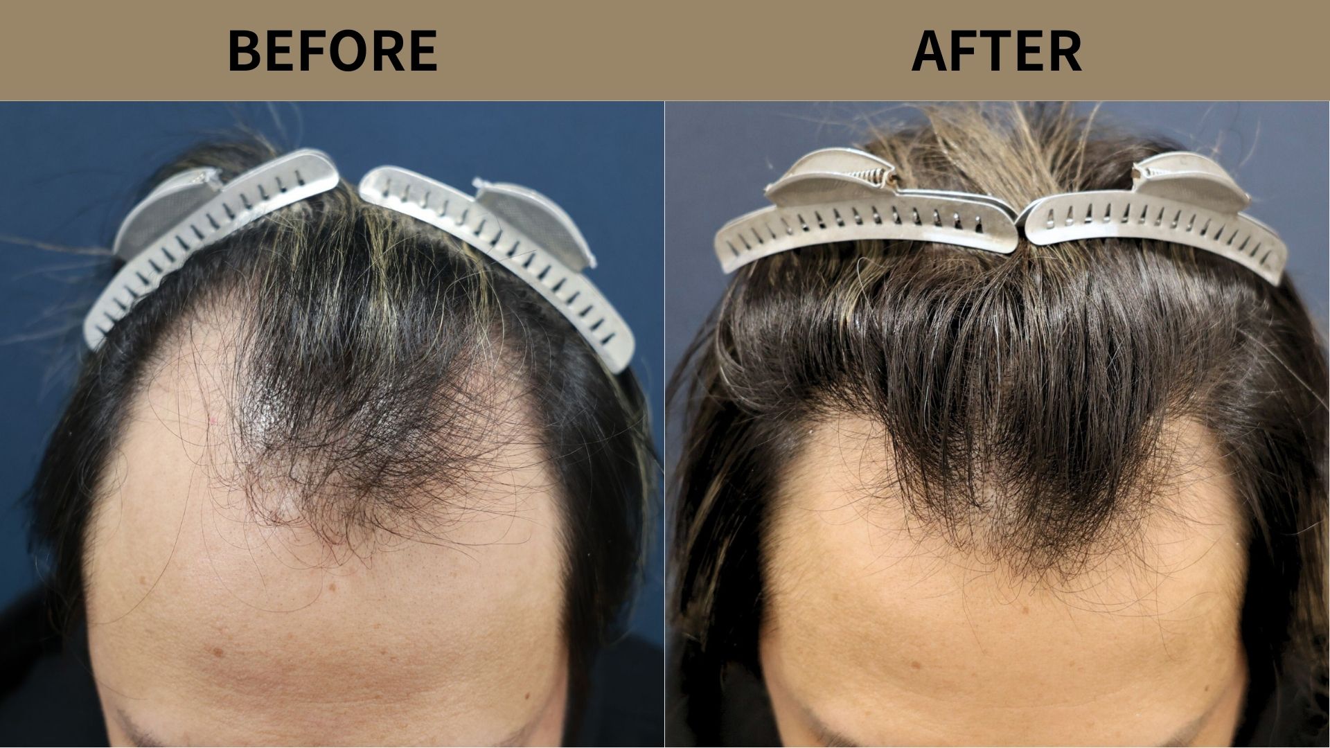 【植毛 症例更新】40代男性｜生え際1200グラフト