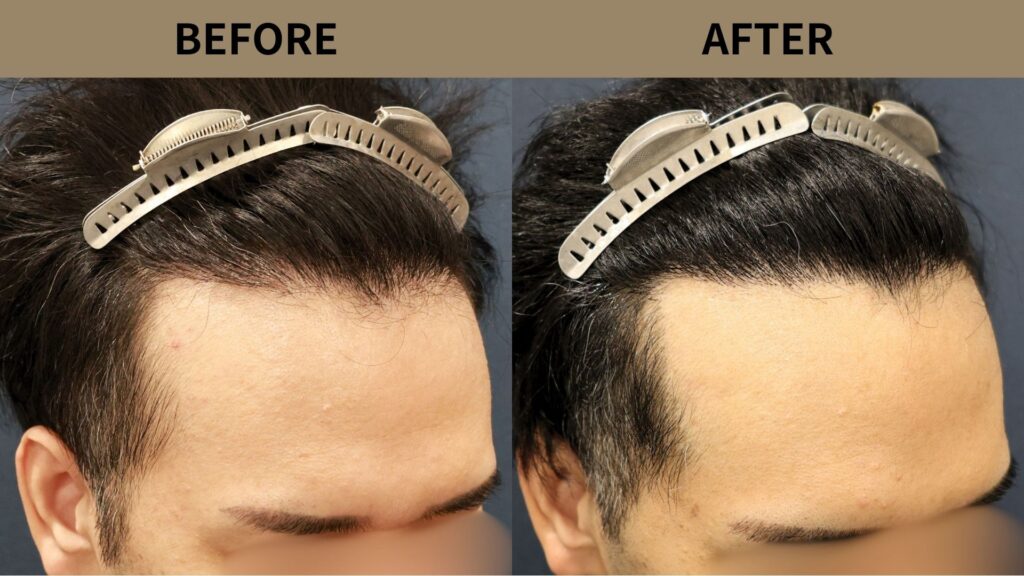 【植毛 症例更新】30代男性｜生え際・密度アップ・他院修正1800グラフト