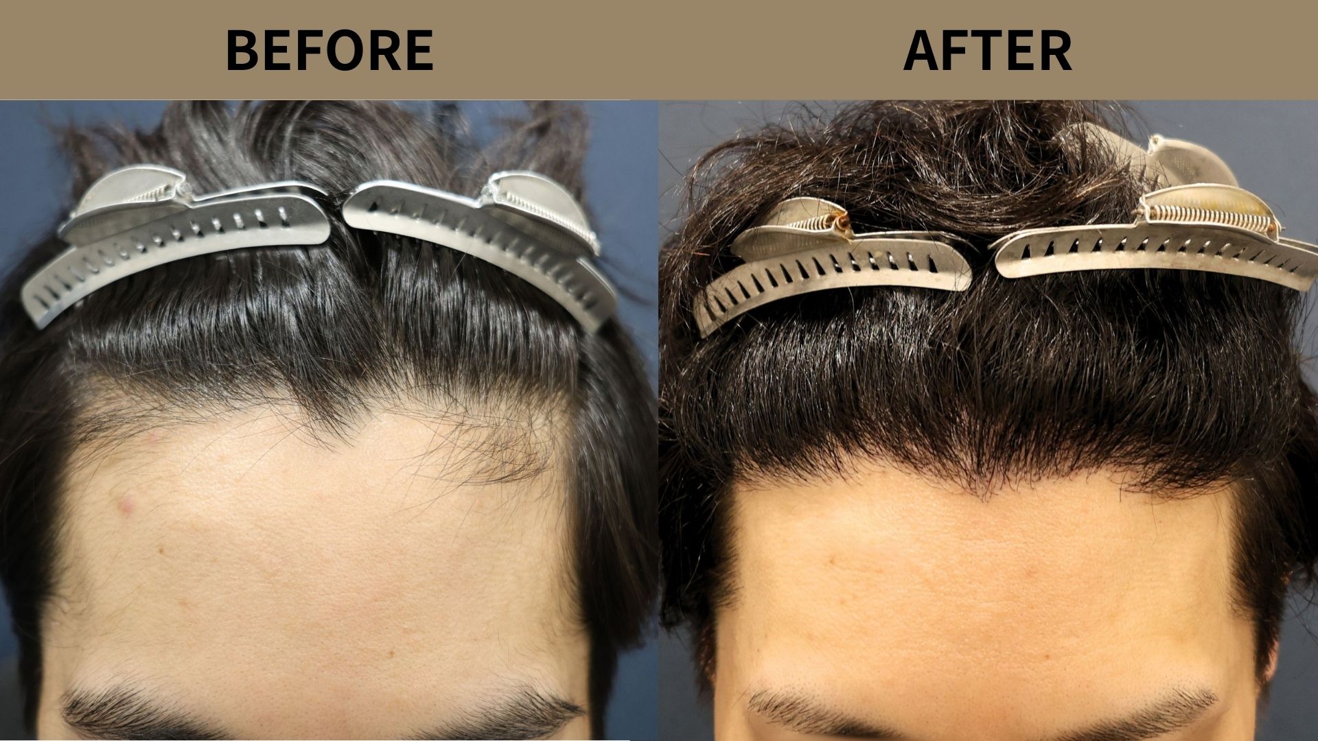 【植毛 症例更新】20代男性｜生え際・当院2回目1000グラフト