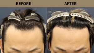 【植毛 症例更新】30代男性｜生え際1200グラフト