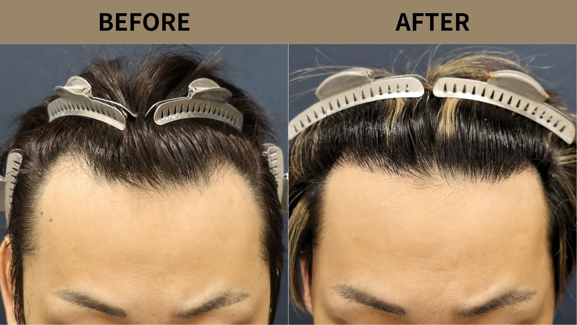 【植毛 症例更新】30代男性｜生え際1200グラフト