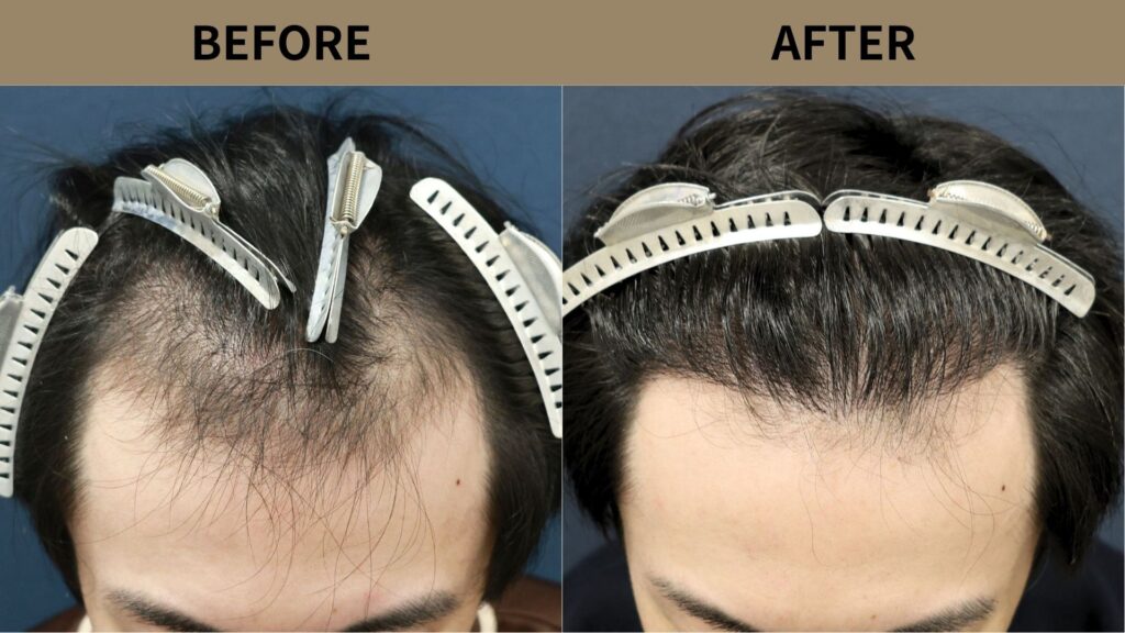 【植毛 症例更新】20代男性｜生え際1600グラフト