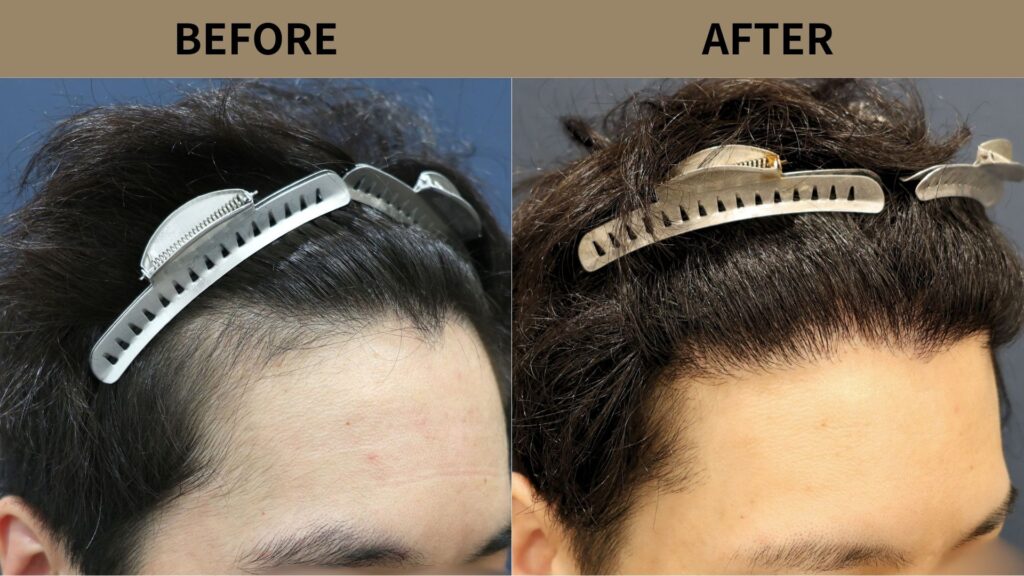 【植毛 症例更新】20代男性|生え際・当院2回目1000グラフト