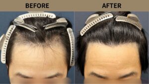 【植毛 症例更新】30代男性｜生え際1400グラフト