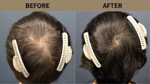 【植毛 症例更新】40代男性｜頭頂部800グラフト