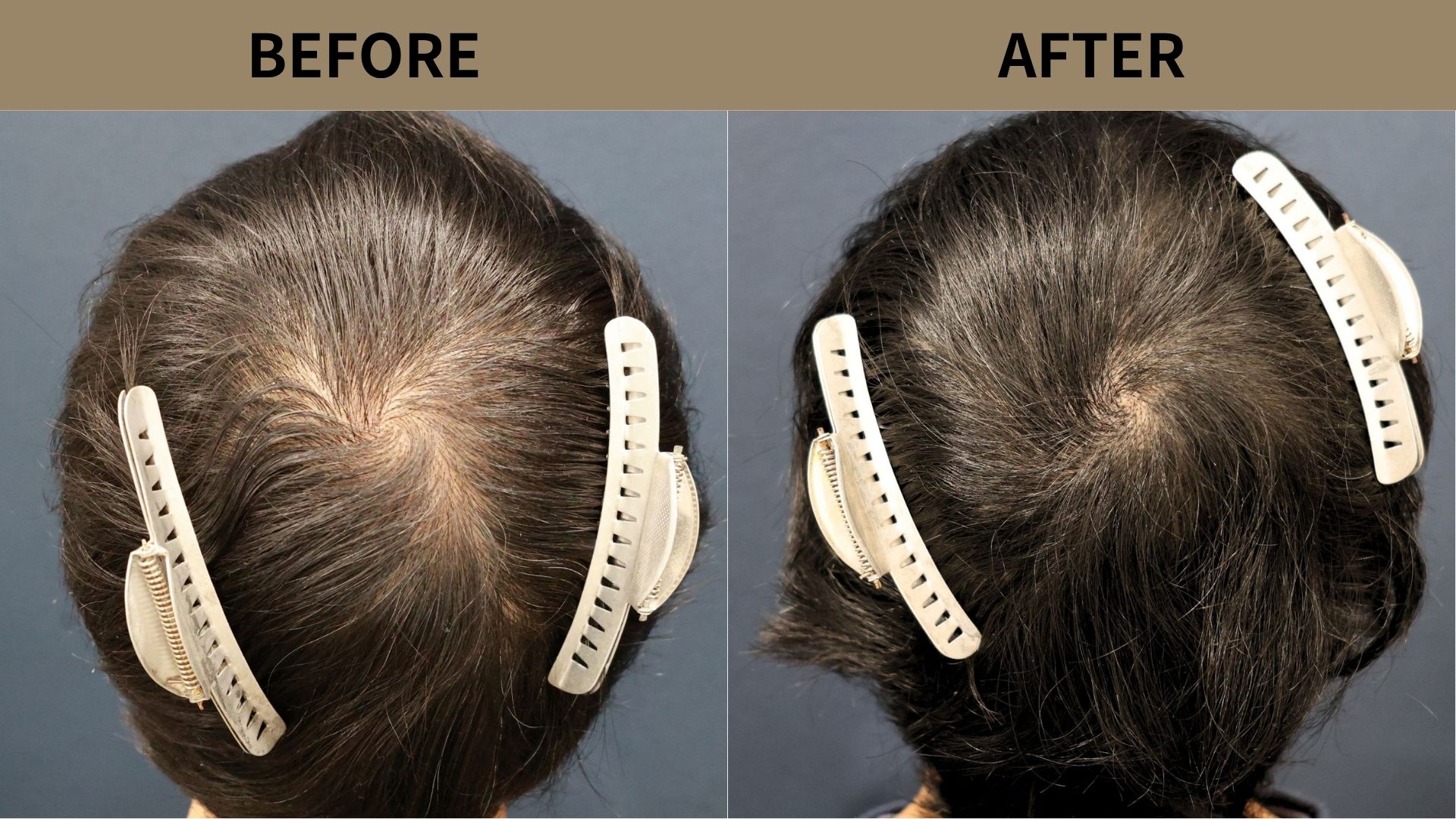 【植毛 症例更新】40代男性｜頭頂部800グラフト