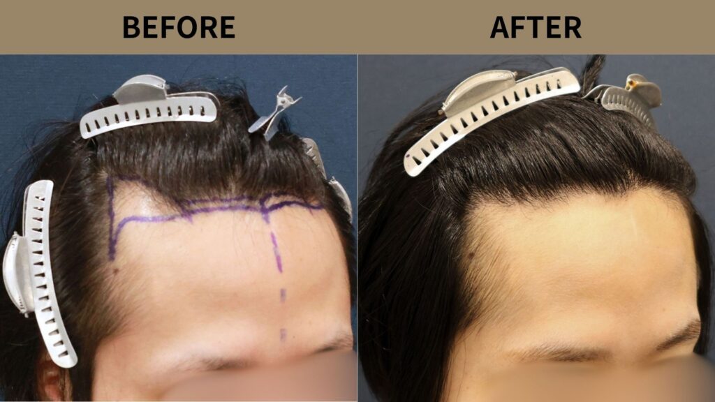 【植毛 症例更新】20代男性｜生え際・M字1300グラフト