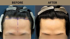 【植毛 症例更新】20代男性｜生え際・M字1300グラフト