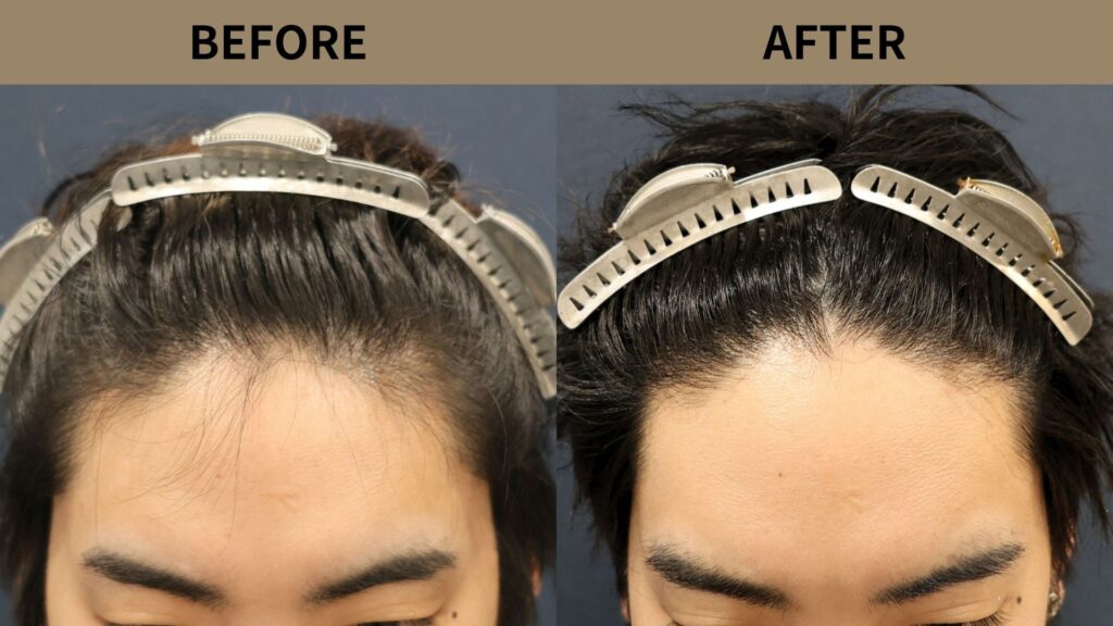 【植毛 症例更新】20代男性｜生え際850グラフト