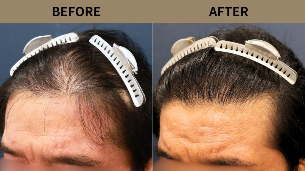 【植毛 症例更新】50代男性|生え際・前頭部・他院修正2200グラフト