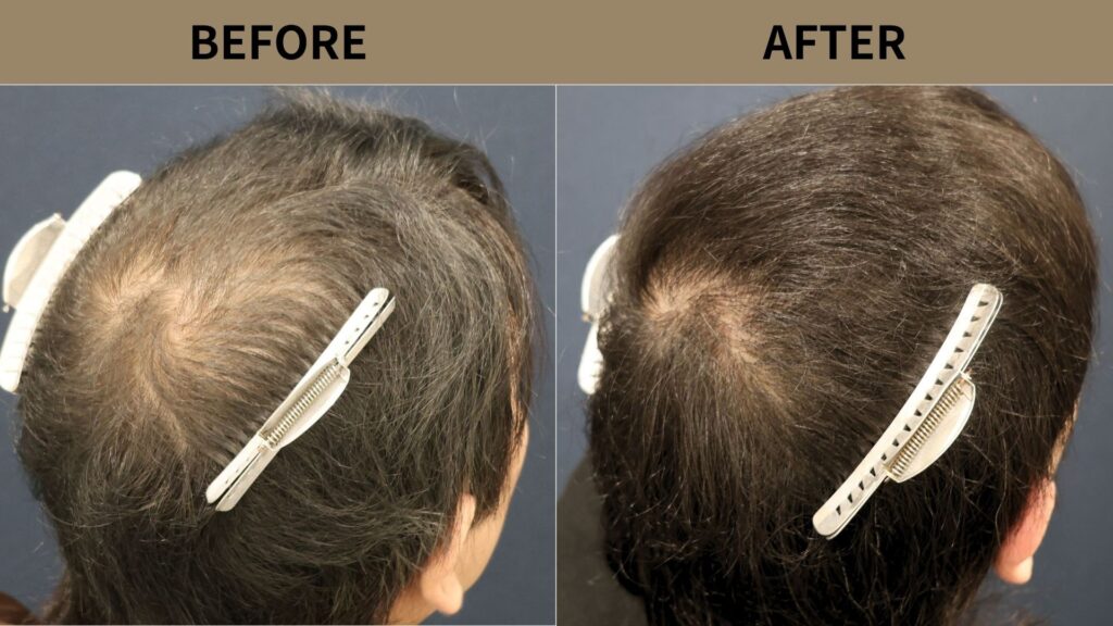 【植毛 症例更新】30代男性｜頭頂部 1000グラフト