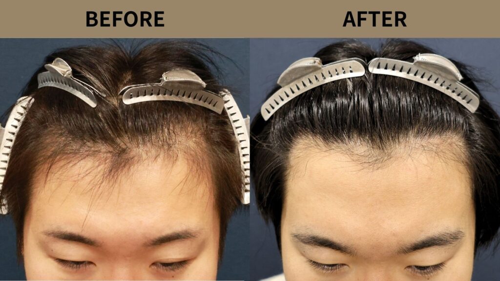 【植毛 症例更新】20代男性｜生え際 1000グラフト