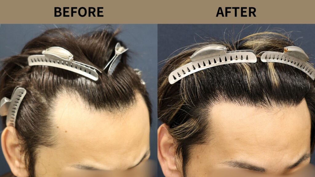 【植毛 症例更新】30代男性｜生え際1200グラフト