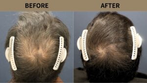 【植毛 症例更新】30代男性｜頭頂部 1000グラフト