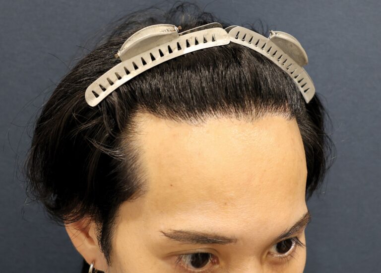 症例写真