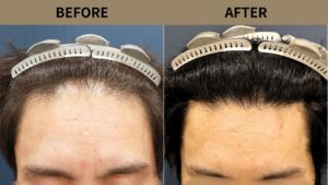 【植毛 症例更新】40代男性｜生え際・他院修正・当院2回目1050グラフト