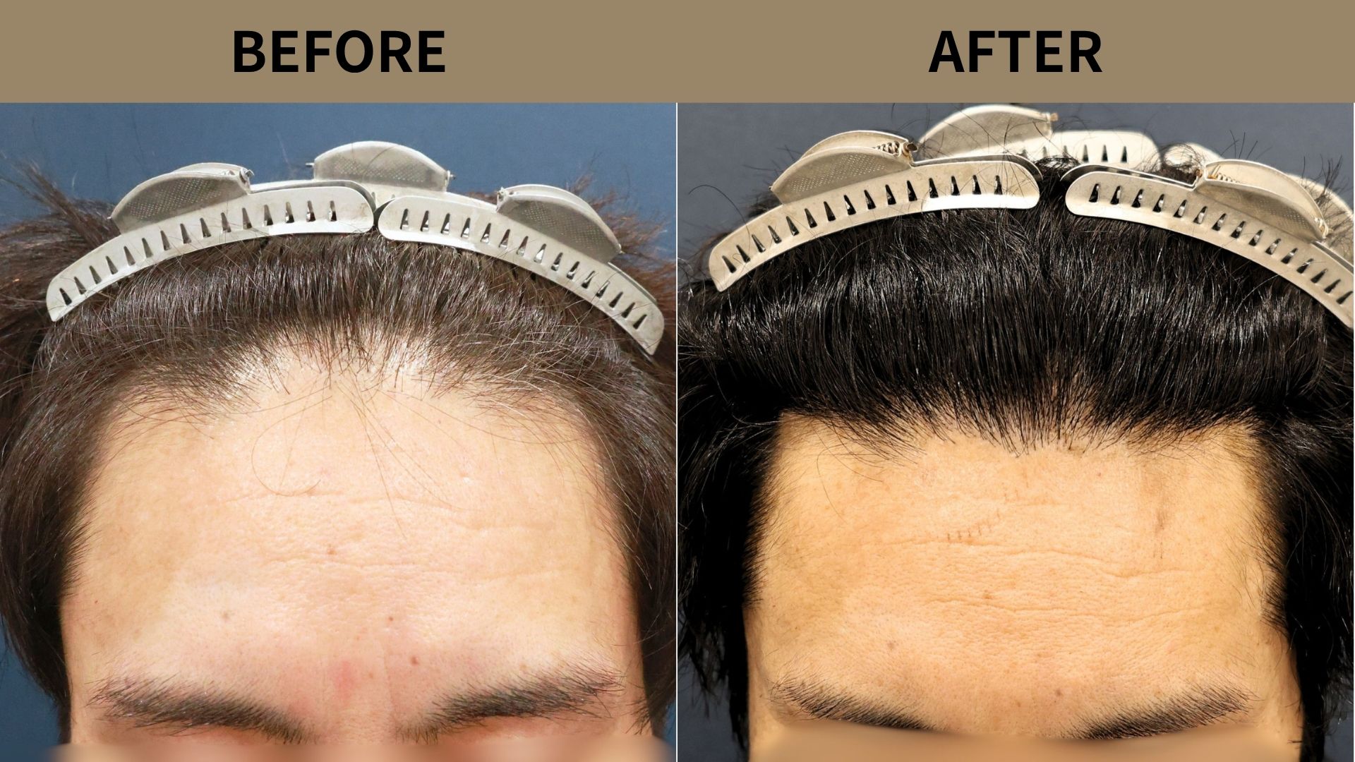 【植毛 症例更新】40代男性｜生え際・他院修正・当院2回目1050グラフト