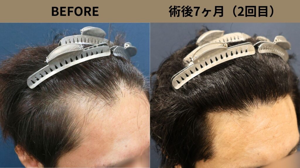【植毛 症例更新】40代男性｜生え際・他院修正・当院2回目1050グラフト