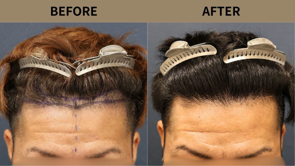 【植毛 症例更新】30代男性｜生え際1200グラフト